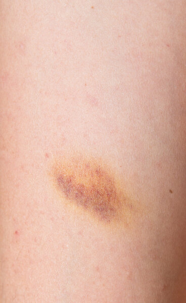 Bruise on skin