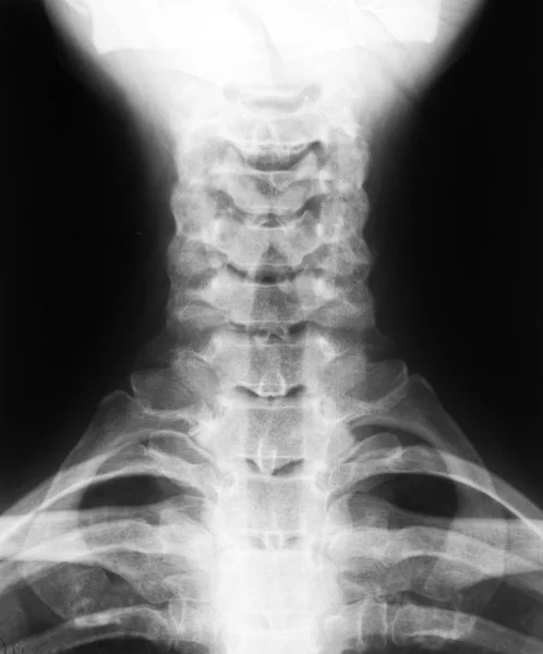 X-ray image of cervical vertebrae — Stock Photo, Image