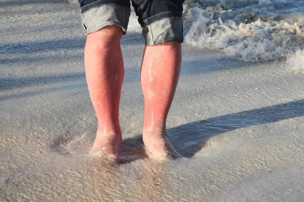 Peau brûlée de soleil sur les jambes de l'homme sur la plage — Photo