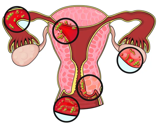 Penyakit sistem reproduksi perempuan - Stok Vektor