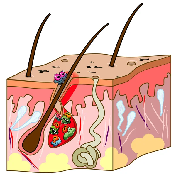 Esquema de pele com acne —  Vetores de Stock