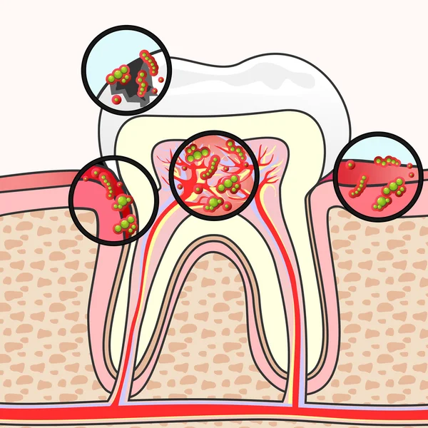 Malattie dentali — Vettoriale Stock