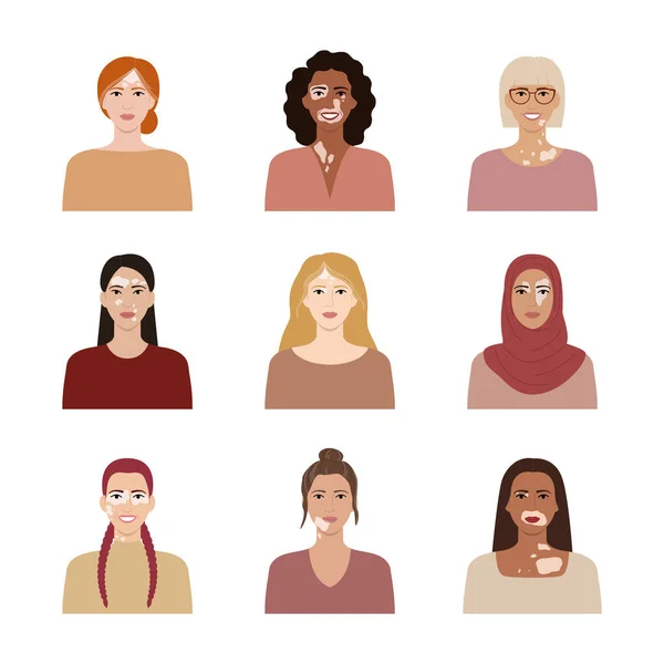 Set Van Vrouwelijke Gezichten Met Vitiligo Portretten Met Verschillende Etniciteit — Stockvector