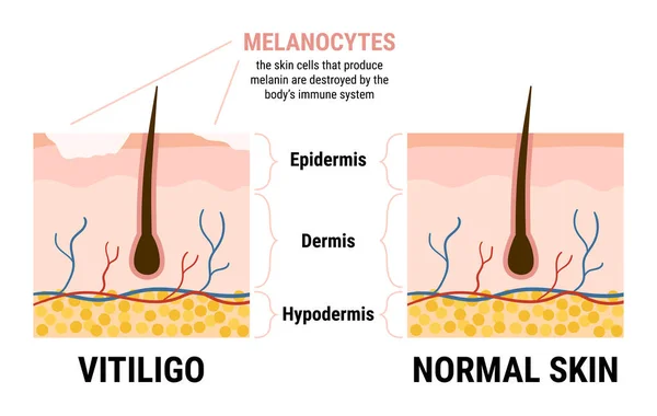Vitiligo Deri Hastalığı Sağlıklı Cilt Bilgisi Melanositler Melanin Üretmeyi Bırakırlar — Stok Vektör