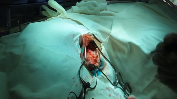 Operation. Operationstisch. Implantation — Stockvideo