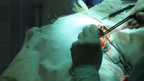 Operatie. chirurgische tabel. implantatie — Stockvideo