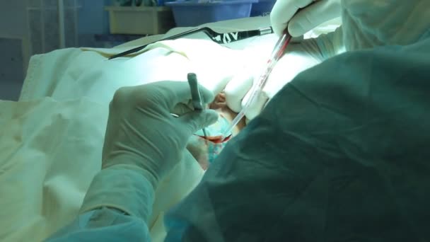 Операция. Хирургический стол — стоковое видео