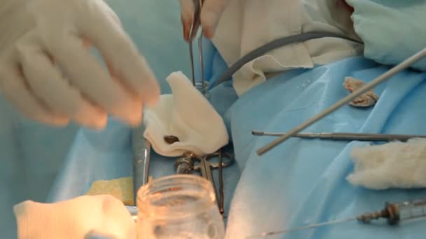 Operasi. Meja bedah. implantasi. Rusia — Stok Video