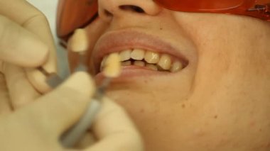 diş beyazlatma. renk düzeltme. stomatology