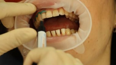 diş beyazlatma. İzolasyon jel yumuşak doku. stomatology