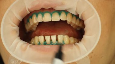 diş beyazlatma. İzolasyon jel yumuşak doku. stomatology