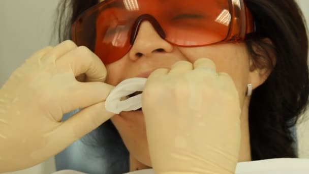 歯を白くします。エキスパンダーのインストール。口腔病学 — ストック動画