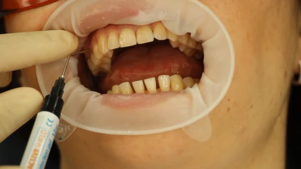 Отбеливание зубов. Изоляционный гель мягких тканей. стоматология — стоковое видео