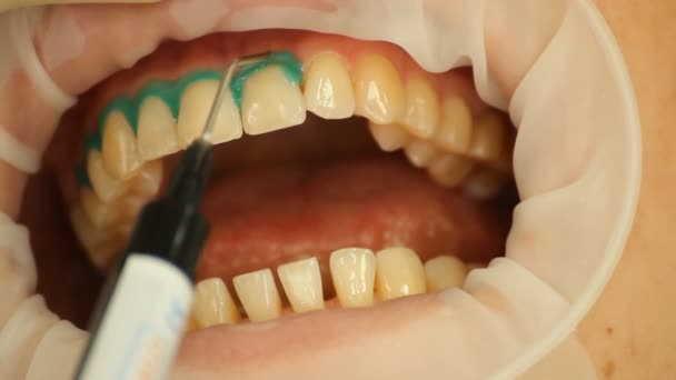 Blanqueamiento de dientes. Gel aislante de tejido blando. estomatología — Vídeo de stock