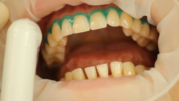 Blanchiment des dents. Gel isolant tissu mou. stomatologie — Video