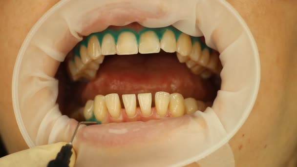 Blanqueamiento de dientes. Gel aislante de tejido blando. estomatología — Vídeos de Stock