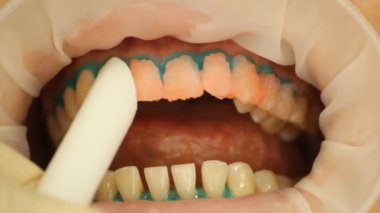 diş beyazlatma. Diş elektrikli süpürge. stomatology