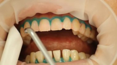 diş beyazlatma. yordam, su ile yıkama. stomatology