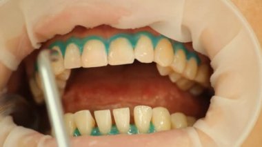 diş beyazlatma. yordam, su ile yıkama. stomatology