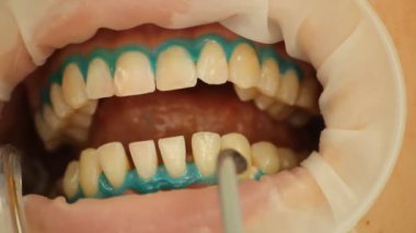 diş beyazlatma. yordam, su ile yıkama. stomatology