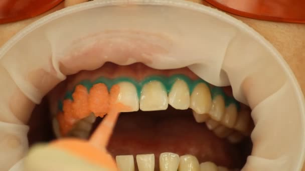 Blanqueamiento de dientes. Aplicación de gel blanqueador a los dientes. estomatología — Vídeos de Stock