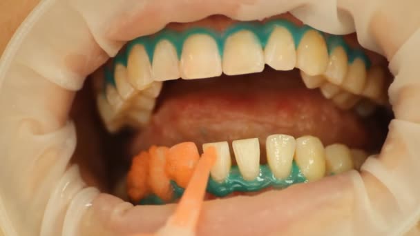 Tanden whitening. toepassing van het gel om de tanden whitening. Afdeling Stomatologie — Stockvideo