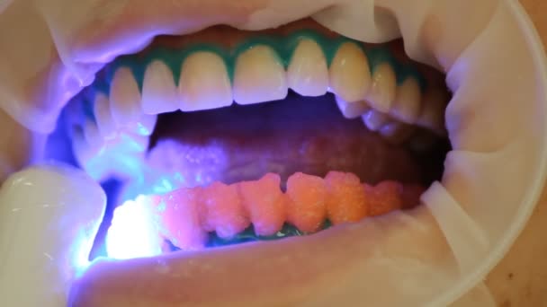 Tanden whitening. de activeringsprocedure van het gel polymerisatie licht. Afdeling Stomatologie — Stockvideo