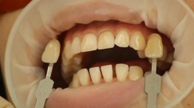 diş beyazlatma. renk kontrol edin. stomatology