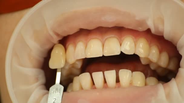 Blanqueamiento de dientes. Compruebe el color. estomatología — Vídeos de Stock