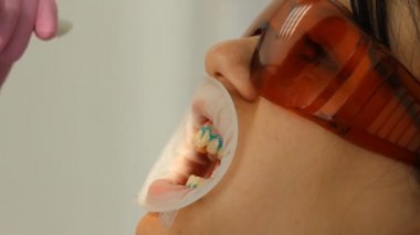 Diş Hekimliği Diş beyazlatma