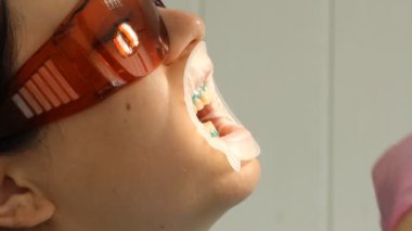 Diş Hekimliği Diş beyazlatma