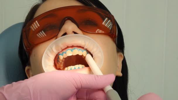 Blanqueamiento dental — Vídeos de Stock