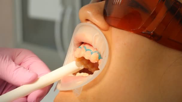 Diş Hekimliği Diş beyazlatma — Stok video