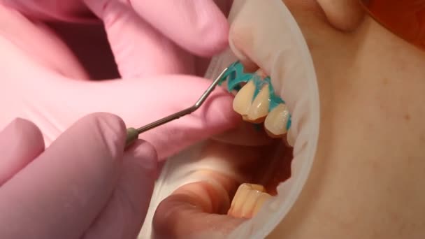 Blanqueamiento dental — Vídeo de stock