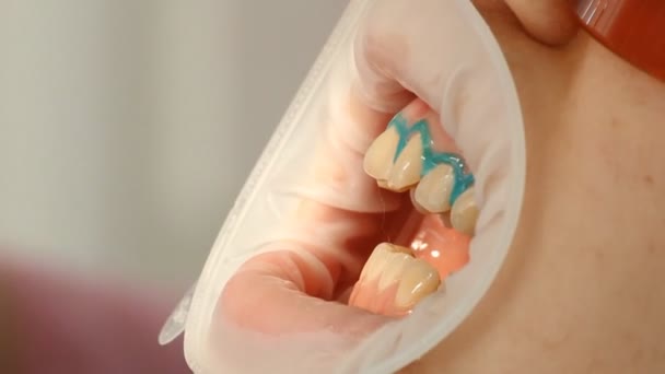 Отбеливание зубов — стоковое видео