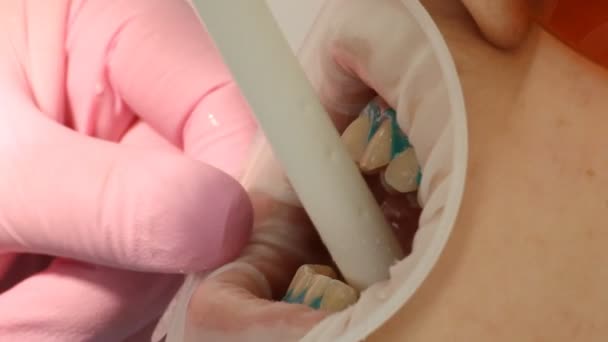 牙齿美白口腔医学 — 图库视频影像