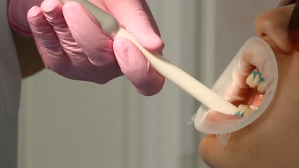 Clareamento dos dentes Odontologia — Vídeo de Stock