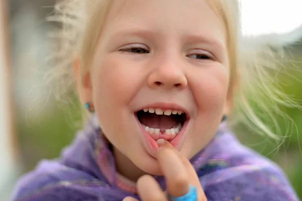 Portrait Little Girl One Milk Tooth Teeth Change Children Dentist — Foto de Stock