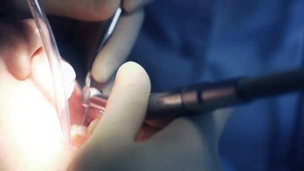 Un dentiste perce une dent — Video