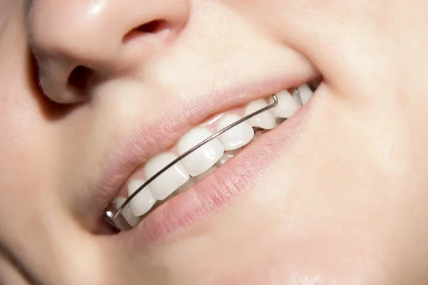 dişlerde diş teli ile gülümseyen genç kız