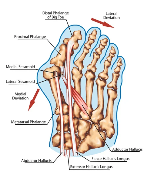 Hallux valgus - pathogenic mechanism, lateral deviation of the first ray with subluxation of the metatarsophalangeal joint — Stock Photo, Image