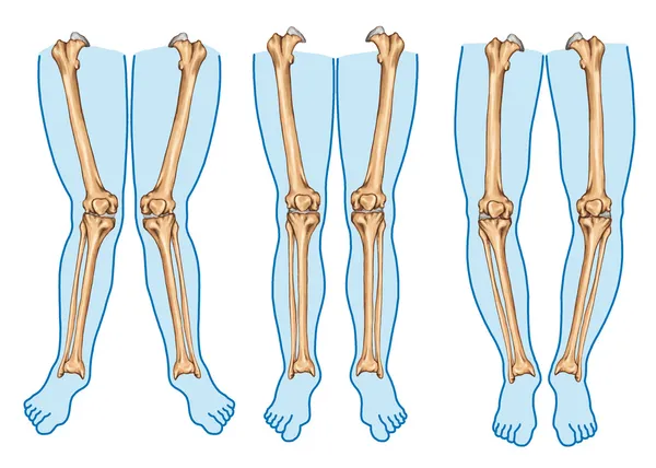Genu varum, genu valgum - una deformidad de las piernas físicas, inclinación de la pierna en relación con el muslo —  Fotos de Stock