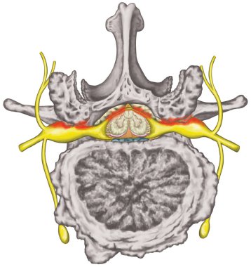 Central lateral stenosis, second lumbar vertebra, nervous system, spinal cord, lumbar spine, nerve root, advanced uncovertebral arthrosis of the lumbar vertebra, degenerative changes vertebra, osteophytes, spondylophytes, osteoarthritis of the joints
