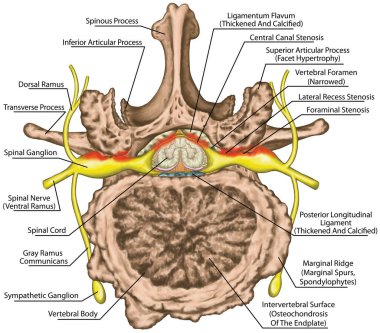 Central lateral stenosis, second lumbar vertebra, nervous system, spinal cord, lumbar spine, nerve root, advanced uncovertebral arthrosis of the lumbar vertebra, degenerative changes vertebra, osteophytes, spondylophytes, osteoarthritis of the joints clipart