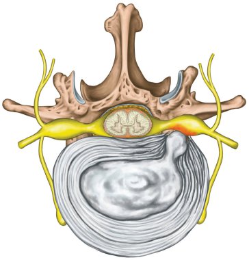 Lumbar disk herniation, herniated disc, lumbar vertebra, lumbar spine, intervertebral disk, nervous system, nerve root, spinal cord, vertebra, anatomy of human skeletal and nervous system, superior view