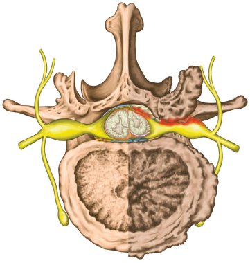 Central lateral stenosis, second lumbar vertebra, nervous system, spinal cord, lumbar spine, nerve root, advanced uncovertebral arthrosis of the lumbar vertebra, degenerative changes vertebra, osteophytes, spondylophytes, osteoarthritis of the joints clipart