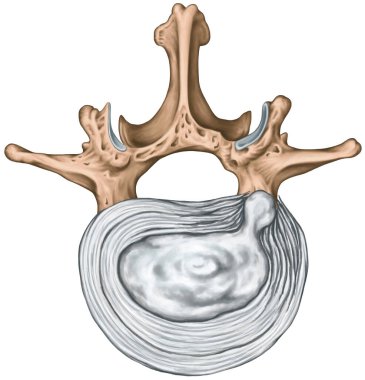 Bel fıtığı, bel fıtığı, bel omuru, bel omuru, omurgalar arası disk, anulus fibrosus, çekirdek pulposus, vertebral kemikler, omurga, insan iskelet sisteminin anatomisi, üstün görüş.