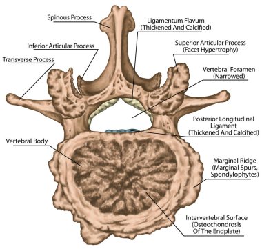 İkinci bel omuru, bel omuru, omurga, omurga, ikinci bel omurunda ileri derecede örtülü olmayan artrosis, dejeneratif omurga, osteofitler, spondilophytler, vertebral vücut, eklemlerde osteoartrit, üst görüş  