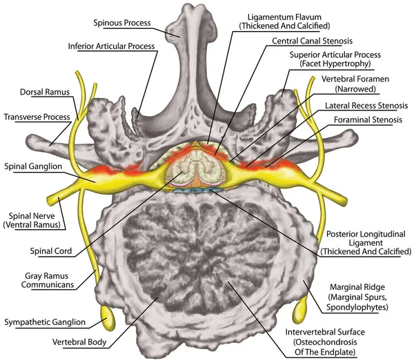 Central lateral stenosis, second lumbar vertebra, nervous system, spinal cord, lumbar spine, nerve root, advanced uncovertebral arthrosis of the lumbar vertebra, degenerative changes vertebra, osteophytes, spondylophytes, osteoarthritis of the joints