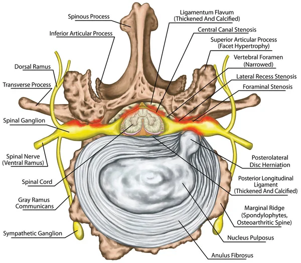 Stenosis Lumbar Disk Herniation Herniated Disc Lumbar Vertebra Osteophytes Spondylophytes — Zdjęcie stockowe